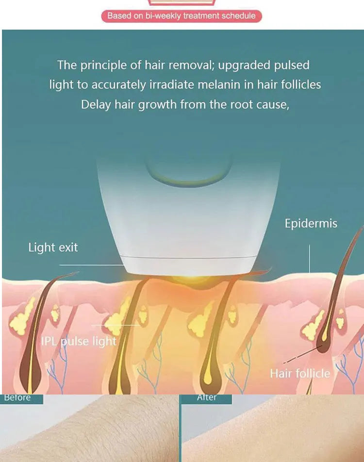 IPL 500.000 Depilador Laser Permanente Indolor Para Mulheres - Dispositivos de Uso Doméstico